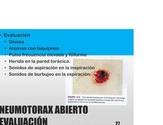 NEUMOTORAX ABIERTO
• Evaluación
• Disnea
• Ansioso con taquipnea
• Pulso frecuencia elevada y filiforme
• Herida en la pared torácica.
• Sonidos de aspiración en la inspiración
• Sonidos de burbujeo en la expiración.
 