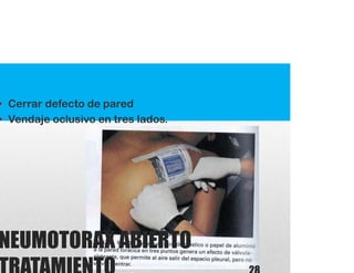 NEUMOTORAX ABIERTO
• Cerrar defecto de pared
• Vendaje oclusivo en tres lados.
 