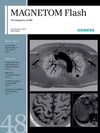 MAGNETOM Flash 
The Magazine of MRI 
Issue Number 3/2011 
RSNA Edition 
How I do it 
Cerebral MR 
Spectroscopy at 
1.5T and 3T 
Page 6 
Clinical 
Surgical Planning 
and Guidance for 
Pediatric Epilepsy 
Page 18 
MRI of the 
Lumbosacral Plexus 
Page 26 
3T MRI of Cartilage 
using 3D DESS 
Page 33 
Simultaneous MR/PET – 
Clinical Reality? 
Page 74 
 