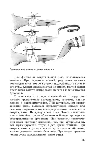 249
Правило наложения жгута и закрутки
Для фиксации повреждённой руки используются
косынки. При переломах костей предплечья косынка
подкладывается под согнутую и подведённую к тулови-
щу руку. Концы завязываются на спине. Третий конец
проводится вокруг локтя сзади наперёд и фиксируется
булавкой.
В зависимости от вида повреждённого сосуда раз-
личают кровотечение артериальное, венозное, капил-
лярное и паренхиматозное. При артериальном крово-
течении кровь вытекает пульсирующей струёй; для
остановки кровотечения сосуд пережимают выше места
повреждения. По цвету кровь алая. Такое кровотече-
ние может быть очень обильным и быстро приводит к
обескровливанию организма. При венозном кровотече-
нии кровь вытекает медленнее, чем при артериальном,
нет пульсирующей струи. Цвет крови тёмный. При
повреждении крупных вен — кровотечение обильное,
может угрожать жизни больного. При таком кровоте-
чении сосуд пережимается ниже раны.
 