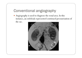 Conventional angiography
 Angiography is used to diagnose the renal area. In this
 instance, an endoleak represented continued pressurization of
 the sac.
 