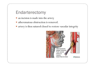 Endarterectomy
 an incision is made into the artery
 atheromatous obstruction is removed.
 artery is then sutured closed to restore vascular integrity
 