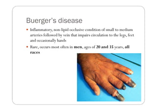 Buerger’s disease
 Inflammatory, non-lipid occlusive condition of small to medium
 arteries followed by vein that impairs circulation to the legs, feet
 and occasionally hands
 Rare, occurs most often in men, ages of 20 and 35 years, all
 races
 
