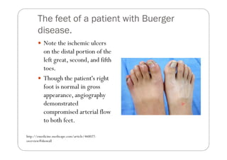The feet of a patient with Buerger
       disease.
           Note the ischemic ulcers
           on the distal portion of the
           left great, second, and fifth
           toes.
           Though the patient's right
           foot is normal in gross
           appearance, angiography
           demonstrated
           compromised arterial flow
           to both feet.

http://emedicine.medscape.com/article/460027-
overview#showall
 