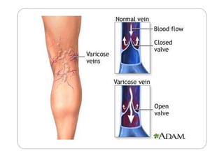 SCLEROTHERAPY
 