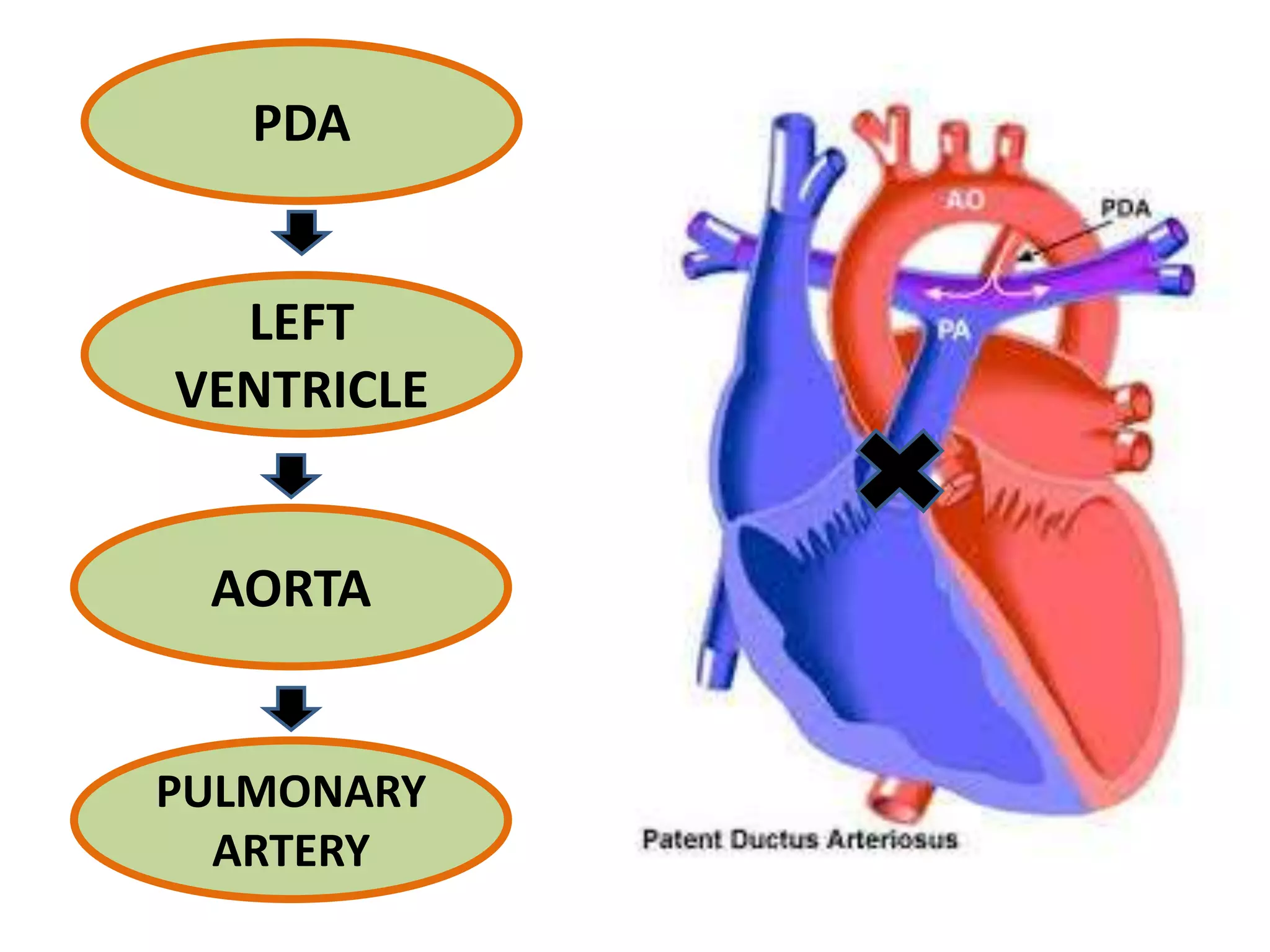 PDA
LEFT
VENTRICLE
AORTA
PULMONARY
ARTERY
 