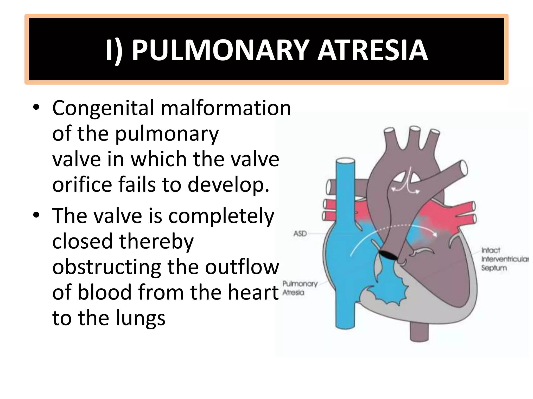 I) PULMONARY ATRESIA
• Congenital malformation
of the pulmonary
valve in which the valve
orifice fails to develop.
• The valve is completely
closed thereby
obstructing the outflow
of blood from the heart
to the lungs
 
