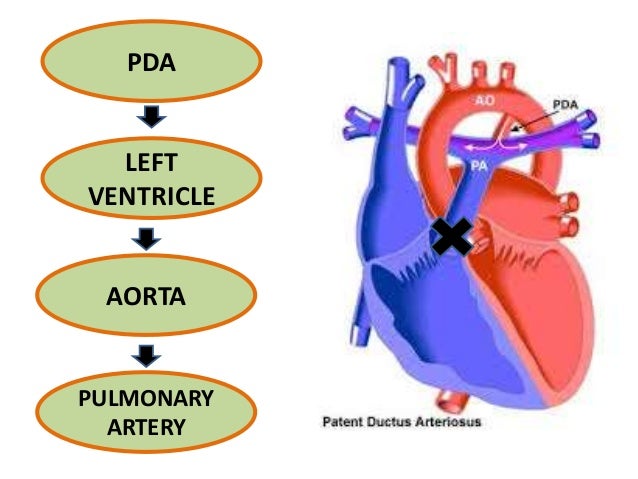 pathophysiology of ductal dependant for pulmonary