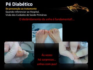 Pé Diabético
Da prevenção ao tratamento
Quando referenciar ao Hospital,
Visão dos Cuidados de Saúde Primários

O desbridamento da unha é fundamental!...

Ás vezes
há surpresas…
unhas com pus!

 