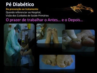 Pé Diabético
Da prevenção ao tratamento
Quando referenciar ao Hospital,
Visão dos Cuidados de Saúde Primários

O prazer de trabalhar o Antes… e o Depois…

 