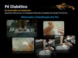 Pé Diabético
Da prevenção ao tratamento
Quando referenciar ao Hospital,Visão dos Cuidados de Saúde Primários
Observação e Classificação dos Pés

 