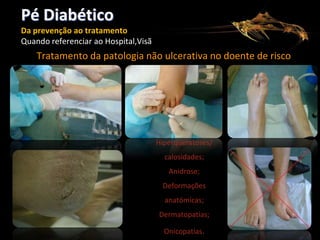 Pé Diabético
Da prevenção ao tratamento
Quando referenciar ao Hospital,Visão dos Cuidados de Saúde Primários

Tratamento da patologia não ulcerativa no doente de risco

Hiperqueratoses/
calosidades;
Anidrose;
Deformações

anatómicas;
Dermatopatias;
Onicopatias.

 