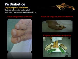Pé Diabético
Da prevenção ao tratamento
Quando referenciar ao Hospital,
Visão dos Cuidados de Saúde Primários

Vasos sanguíneos anómalos

Alívios de carga ou pressão anómala

Calçado e palmilhas adequadas

 
