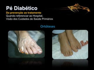 Pé Diabético
Da prevenção ao tratamento
Quando referenciar ao Hospital,
Visão dos Cuidados de Saúde Primários

Ortóteses

 