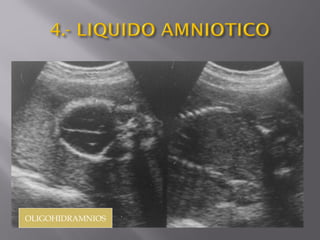 OLIGOHIDRAMNIOS
 