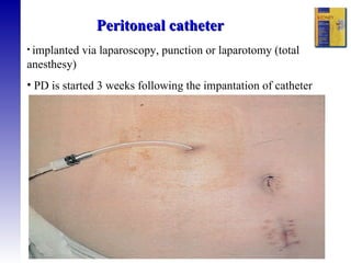 Peritoneal catheter implanted via laparoscopy, punction or laparotomy (total  anesthesy) PD is started 3 weeks following the impantation of catheter 
