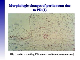 Morphologic changes of peritoneum due to PD (1) Obr.1-before starting PD, norm. peritoneum (omentum) 