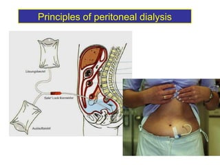 Principles of peritoneal dialysis 