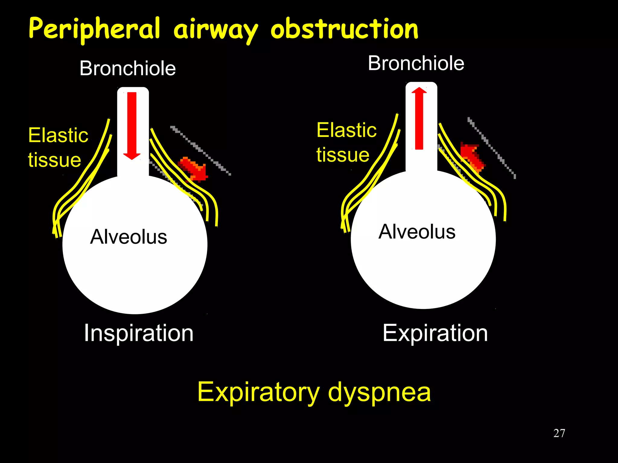 Alveolus
Inspiration
Bronchiole
Elastic
tissue
Expiration
Expiratory dyspnea
Alveolus
Bronchiole
Elastic
tissue
Peripheral airway obstruction
27
 