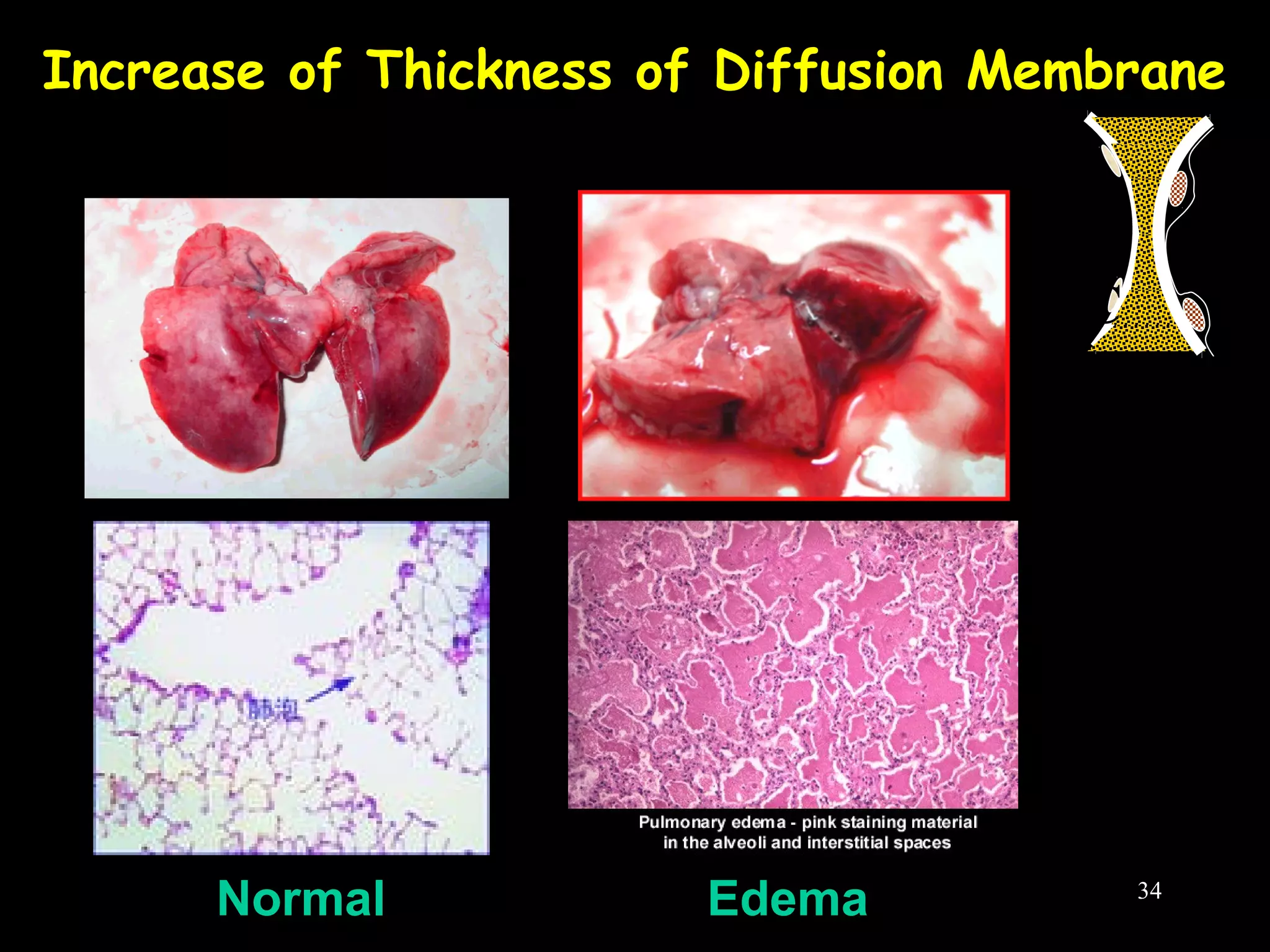 Increase of Thickness of Diffusion Membrane
Normal Edema
C
O
2
34
 