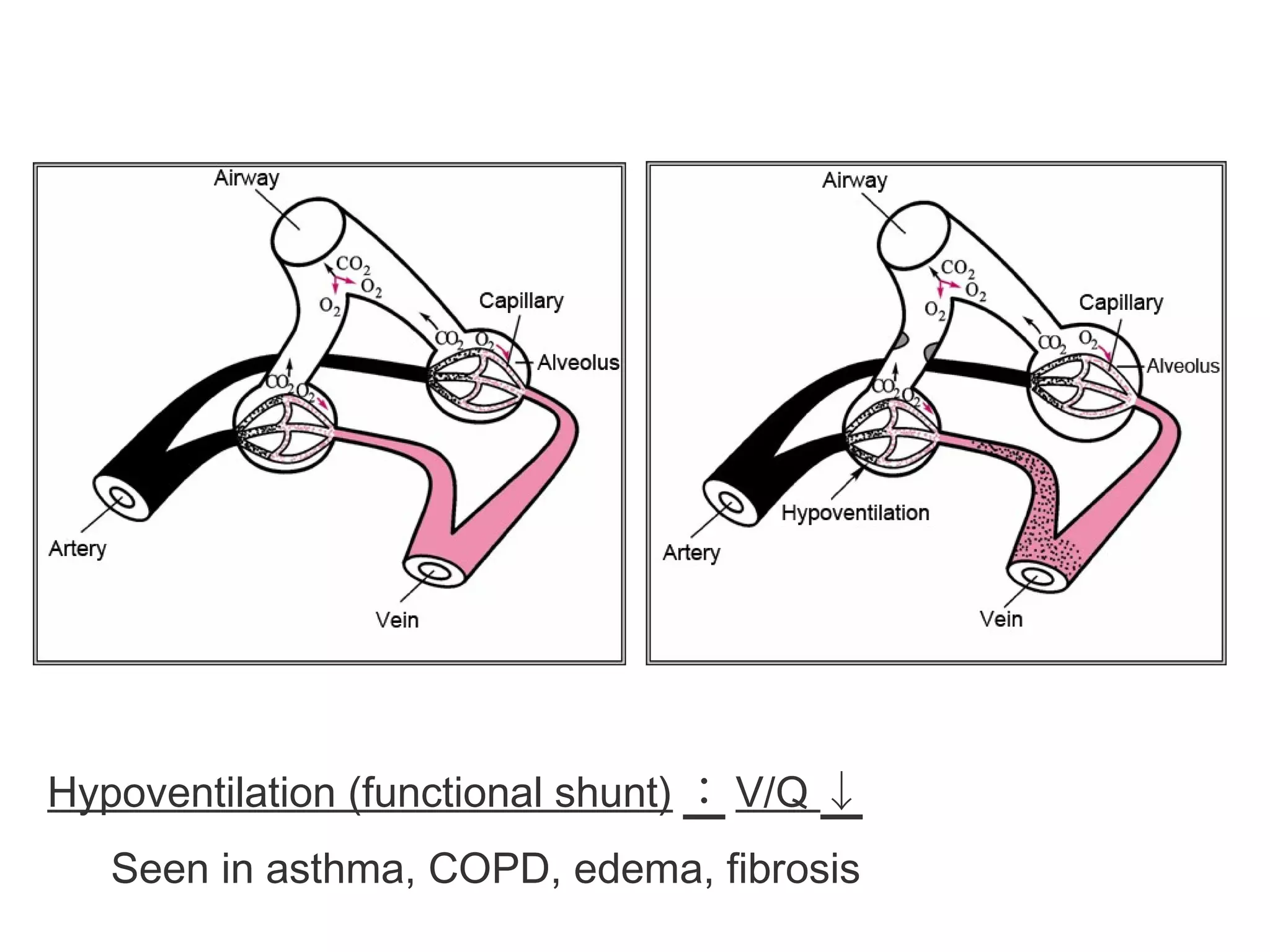 Normal Functional Shunt
Hypoventilation (functional shunt) ： V/Q ↓
Seen in asthma, COPD, edema, fibrosis
 
