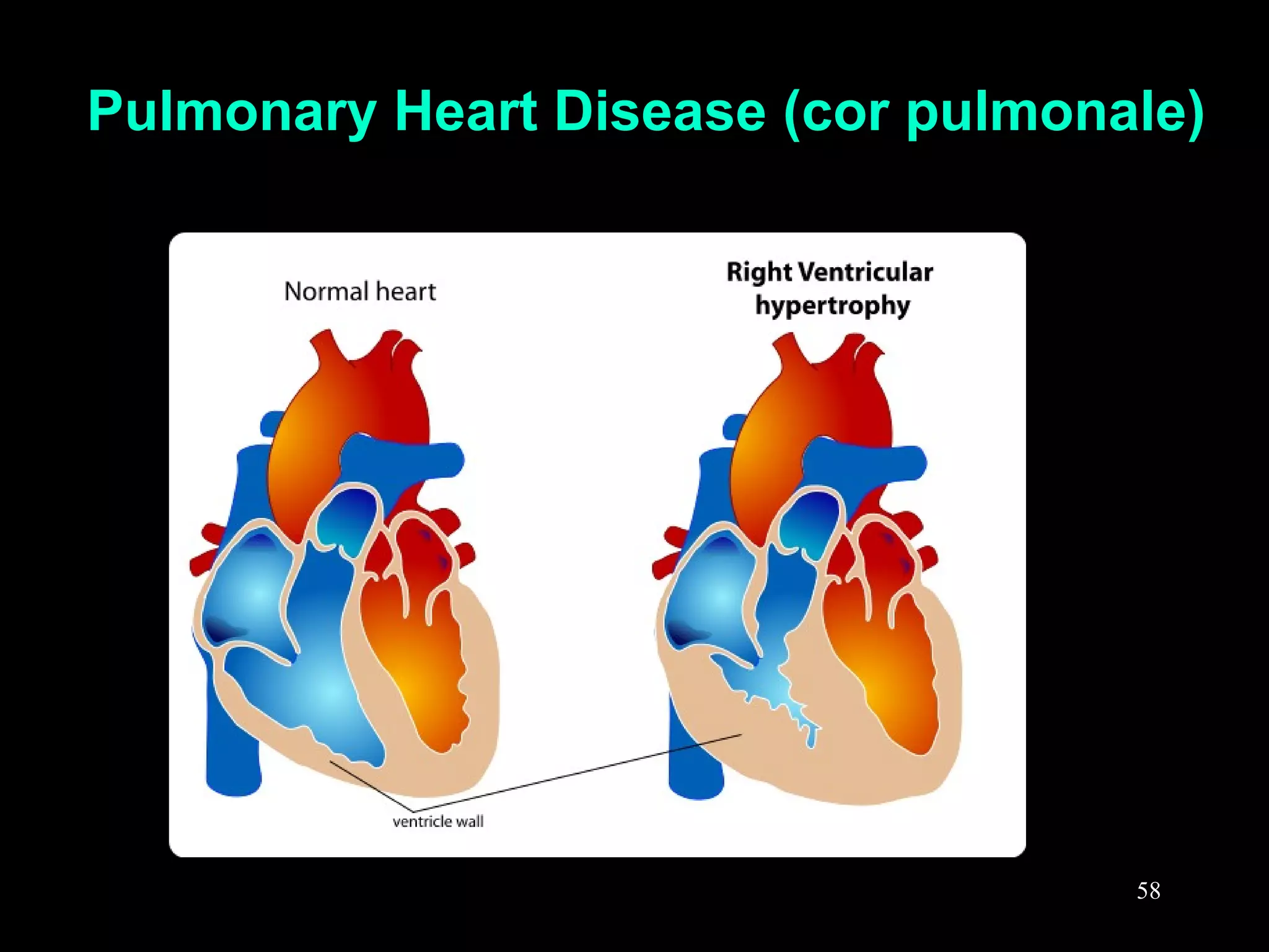 Pulmonary Heart Disease (cor pulmonale)
58
 