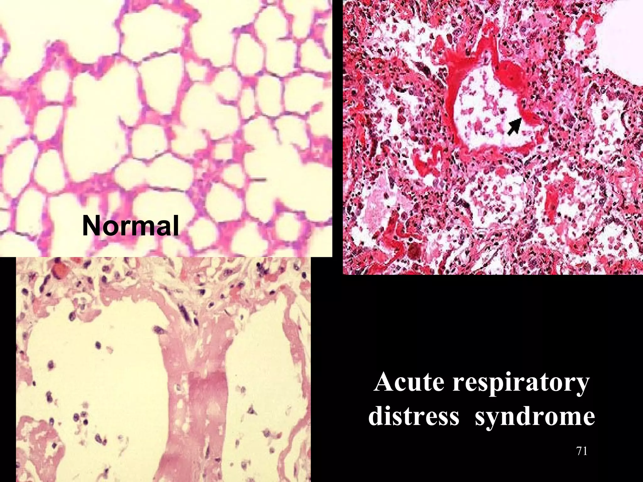 Acute respiratory
distress syndrome
Normal
71
 