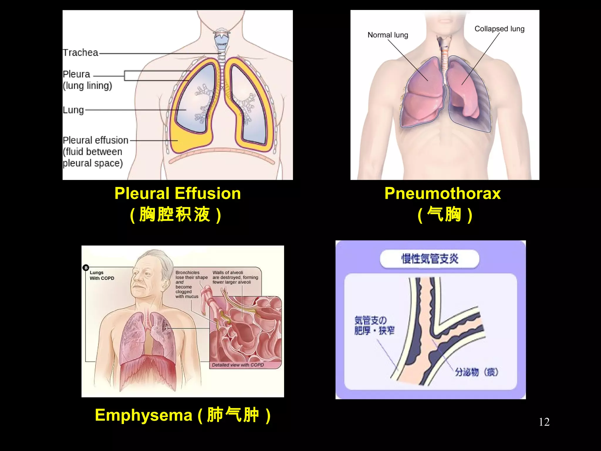 ( 气胸 )( 胸腔积液 )
Pleural Effusion Pneumothorax
Emphysema ( 肺气肿 ) 12
 