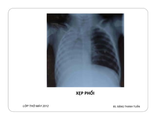 BS. ĐẶNG THANH TUẤNL P TH MÁY 2012
XẸP PHỔI
 