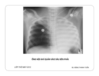 BS. ĐẶNG THANH TUẤNL P TH MÁY 2012
ỐNG NỘI KHÍ QUẢN VÀO SÂU BÊN PHẢI
 