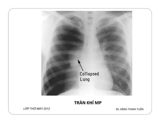 BS. ĐẶNG THANH TUẤNL P TH MÁY 2012
TRÀN KHÍ MP
 