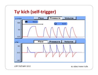 Tự kích (self-trigger)
Assist
Mand
BS. ĐẶNG THANH TUẤNL P TH MÁY 2012
 
