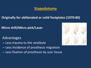 Stapedectomy: Definition, Surgery, Procedure & Recovery