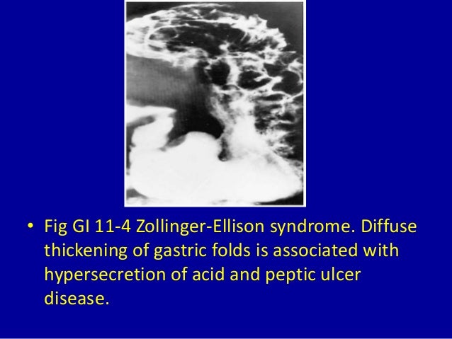 11 thickening of gastric folds