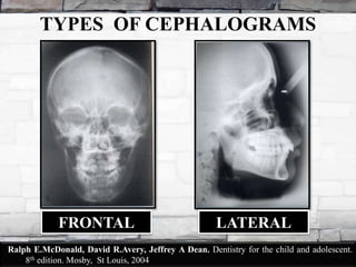 Cepalometrics | PPTX