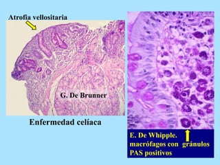 Enfermedad celíaca
Atrofia vellositaria
E. De Whipple.
macrófagos con gránulos
PAS positivos
G. De Brunner
 