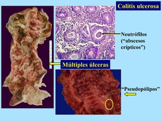Colitis ulcerosa
Neutrófilos
(“abscesos
crípticos”)
“Pseudopólipos”
Múltiples úlceras
 
