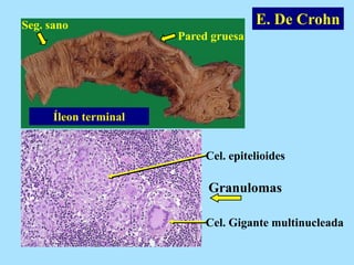 E. De Crohn
Íleon terminal
Seg. sano
Granulomas
Pared gruesa
Cel. epitelioides
Cel. Gigante multinucleada
 