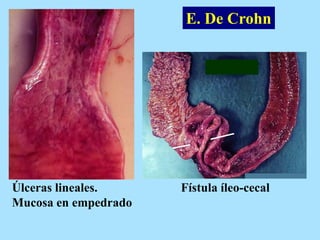 E. De Crohn
Fístula íleo-cecalÚlceras lineales.
Mucosa en empedrado
 