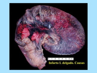 Infarto I. delgado. Causas
 