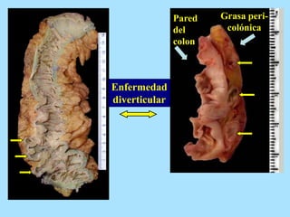 Enfermedad
diverticular
Grasa peri-
colónica
Pared
del
colon
 