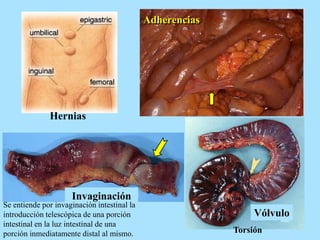 Hernias
Invaginación
Vólvulo
Adherencias
Se entiende por invaginación intestinal la
introducción telescópica de una porción
intestinal en la luz intestinal de una
porción inmediatamente distal al mismo. Torsión
 