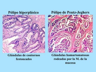Pólipo hiperplásico Pólipo de Peutz-Jeghers
Glándulas de contornos
festoneados
Glándulas hamartomatosas
rodeadas por la M. de la
mucosa
 