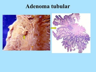 Adenoma tubular
 