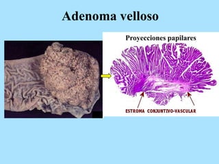 Adenoma velloso
Proyecciones papilares
 