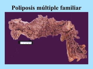 Poliposis múltiple familiar
 