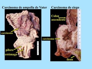 Carcinoma de ampolla de Vater Carcinoma de ciego
píloro
estómago
Colon
ascendente
íleon
carcinoma
carcinoma
 