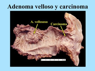 Adenoma velloso y carcinoma
A. vellososo
Carcinoma
 