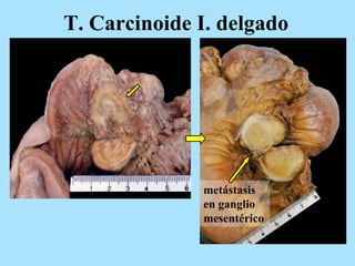 T. Carcinoide I. delgado
metástasis
en ganglio
mesentérico
 