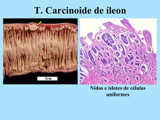 T. Carcinoide de íleon
Nidos e islotes de células
uniformes
 